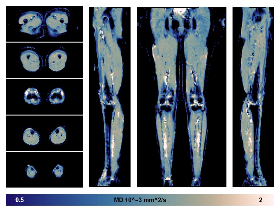 IVIM corrected whole leg muscle mean diffusivity obtained from diffusion tensor imaging.